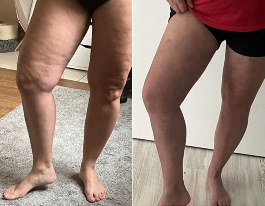 Antes e depois celulite
