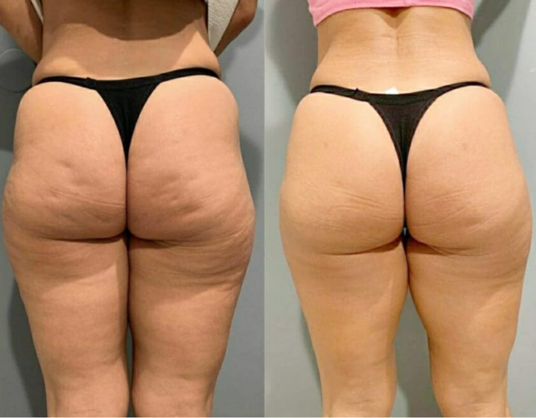 Antes e depois flacidez