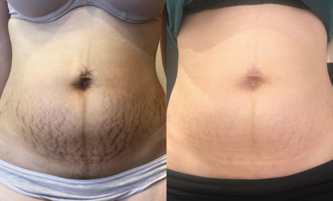 Antes e depois estrias