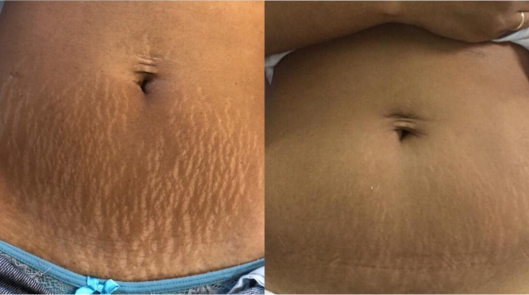 Antes e depois estrias